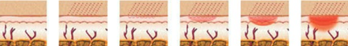 Microneedle rf frazionaria Thermage, attrezzatura non invadente di bellezza di terapia rf