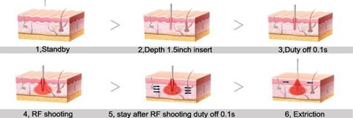 Microneedle rf frazionaria Thermage, attrezzatura non invadente di bellezza di terapia rf