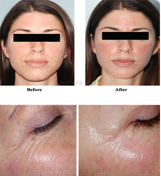 Microneedle rf frazionaria Thermage, attrezzatura non invadente di bellezza di terapia rf